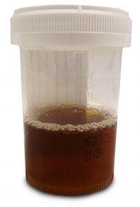 Coca-Cola colored urine caused by rhabdomyolysis