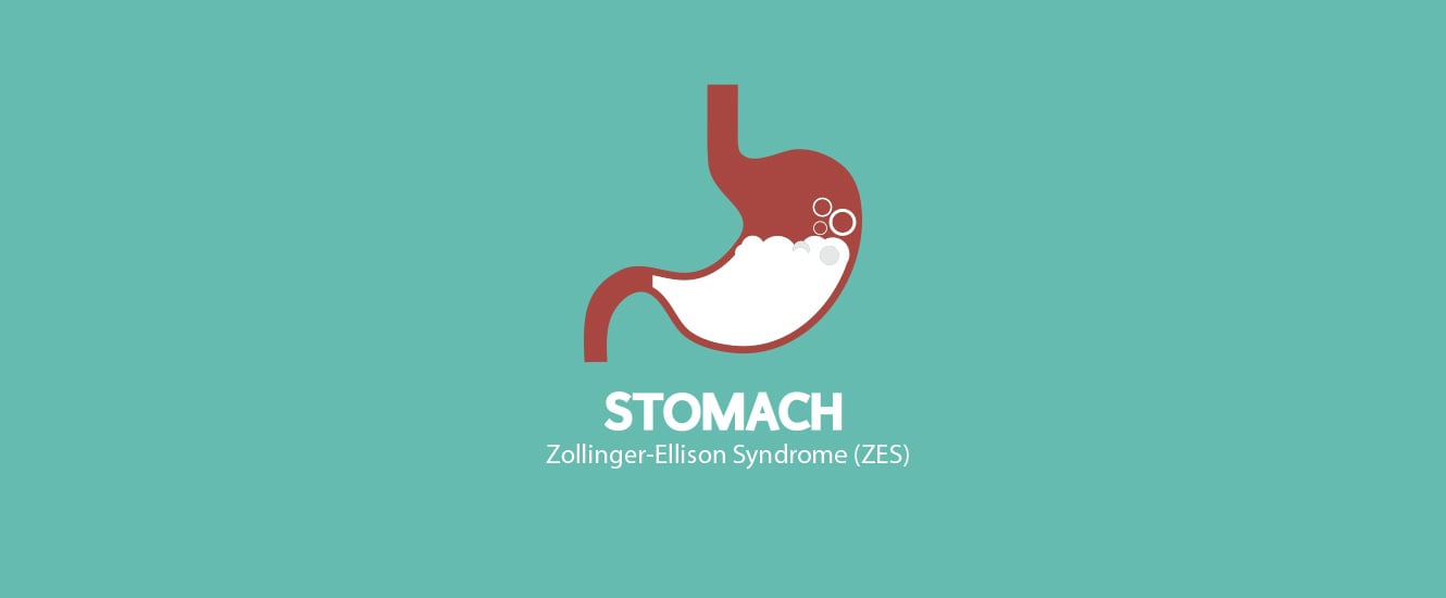 Zollinger Ellison Syndrome